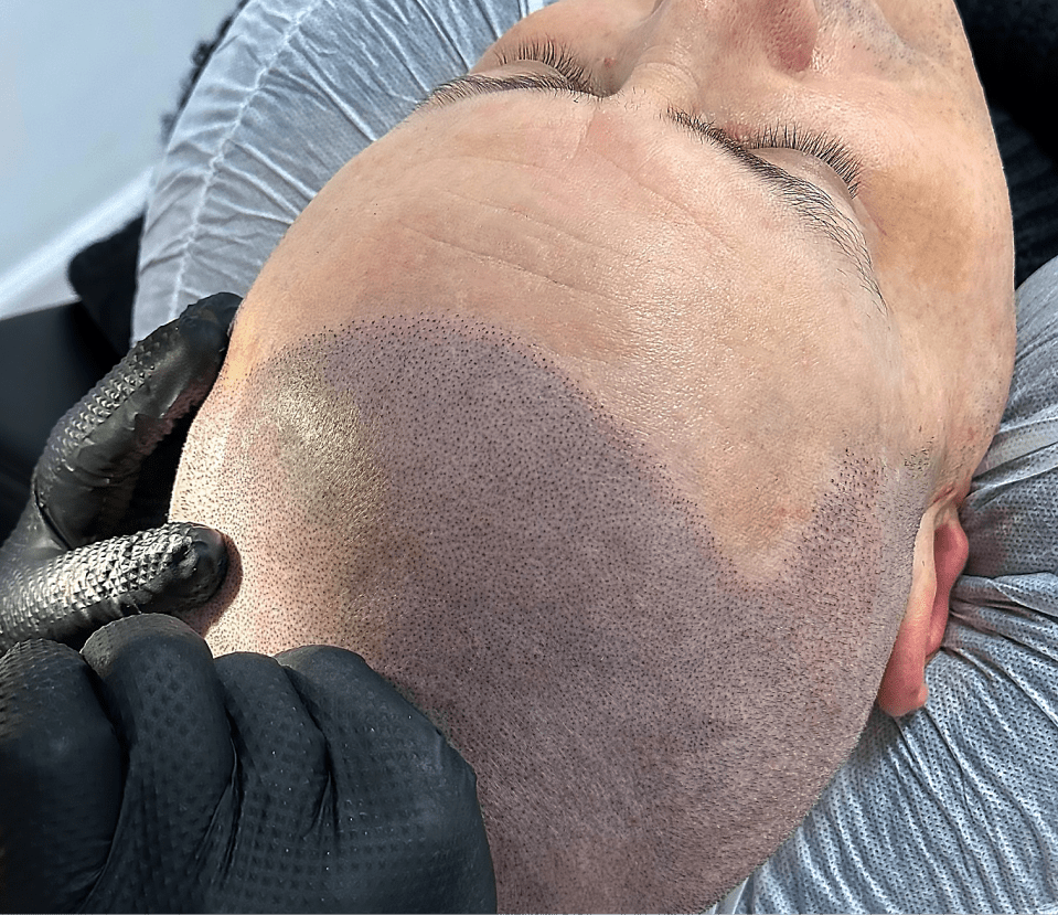 scalp micro pigmentation