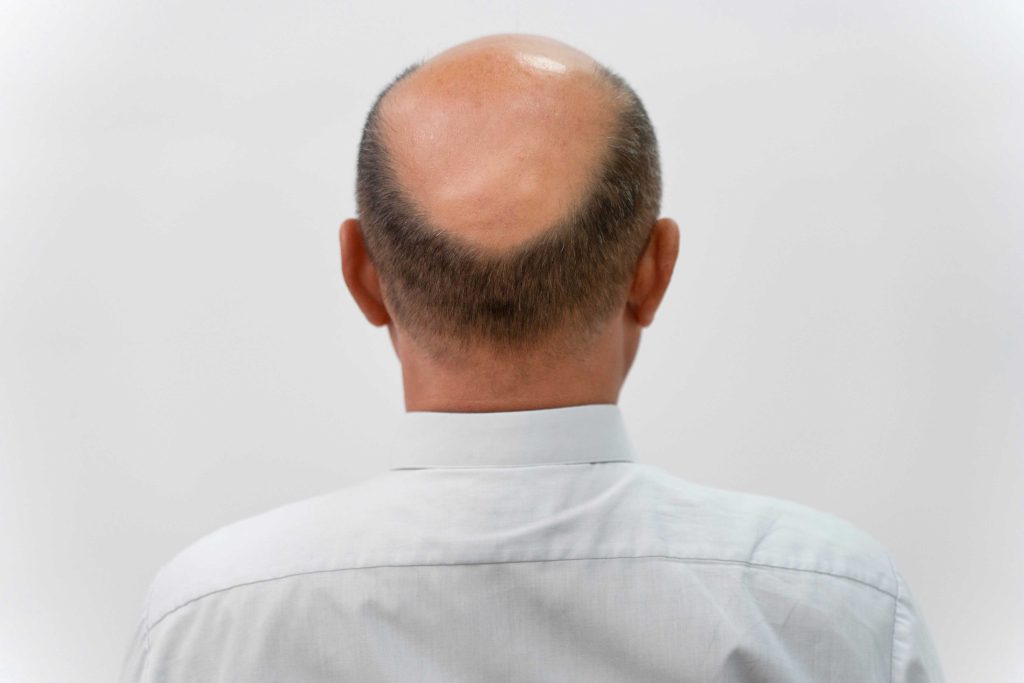 Solution for Male Pattern Baldness in New York