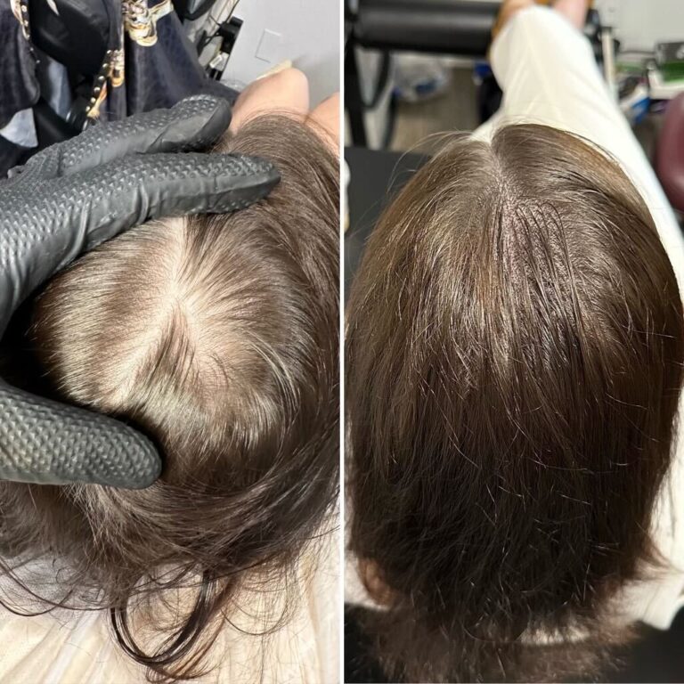 Micropigmentation Scalp