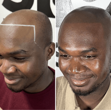 Cost scalp micropigmentation