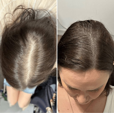 Scalp Micropigmentation