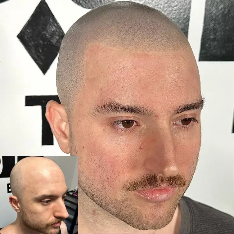 Hair Transplant After 10 Days