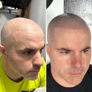IS A HAIR TRANSPLANT POSSIBLE WITHOUT SHAVING YOUR HEAD?
