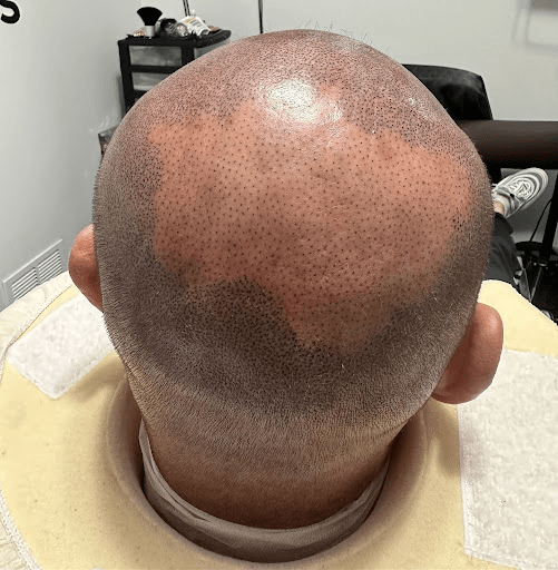 Hair Loss Tattoo