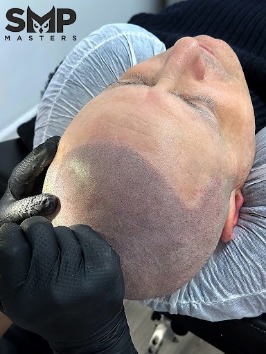 Scalp Micropigmentation Regrets