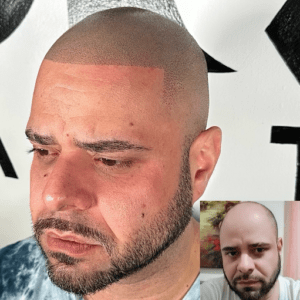 Aftercare 10 days after your hair transplant