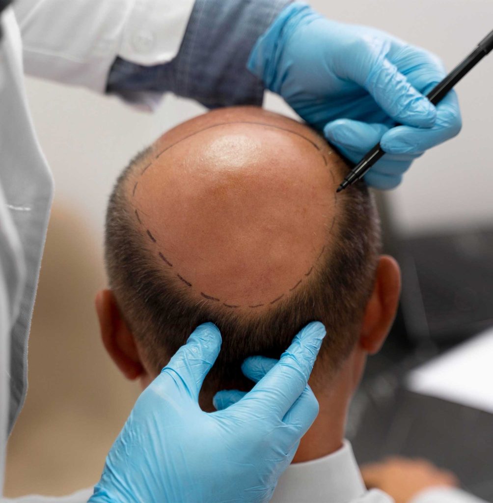 Exploring the Best Micropigmentation Treatments for Hair Loss