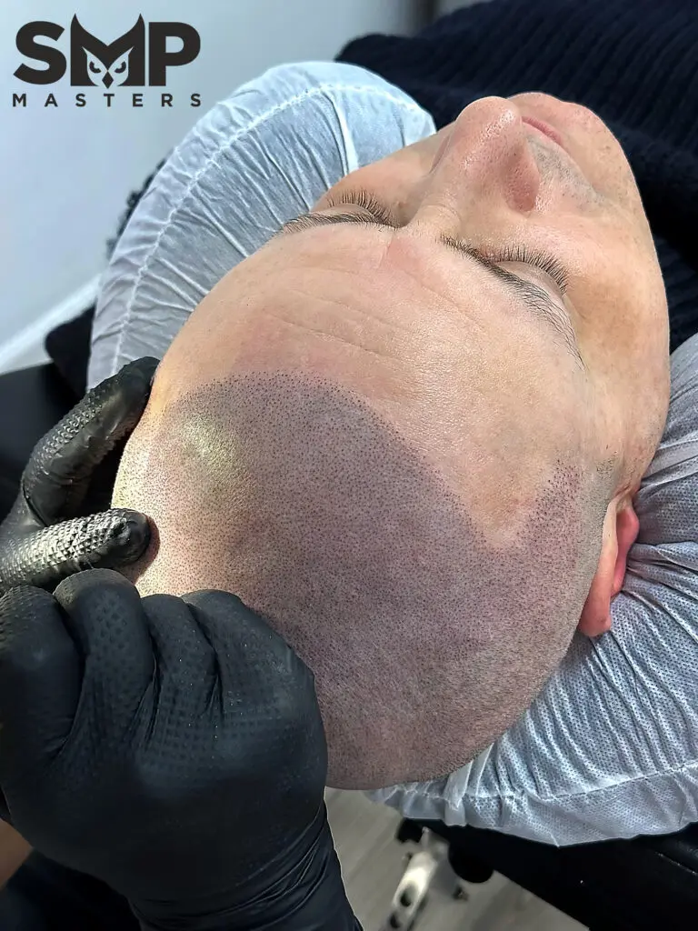 Who Benefits from Micropigmentation? — Got Scalp