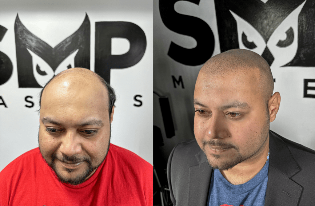 Alopecia Solutions Treatment