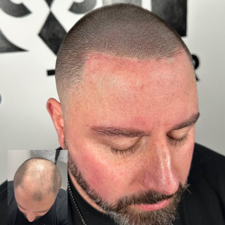 Scalp Micropigmentation NYC