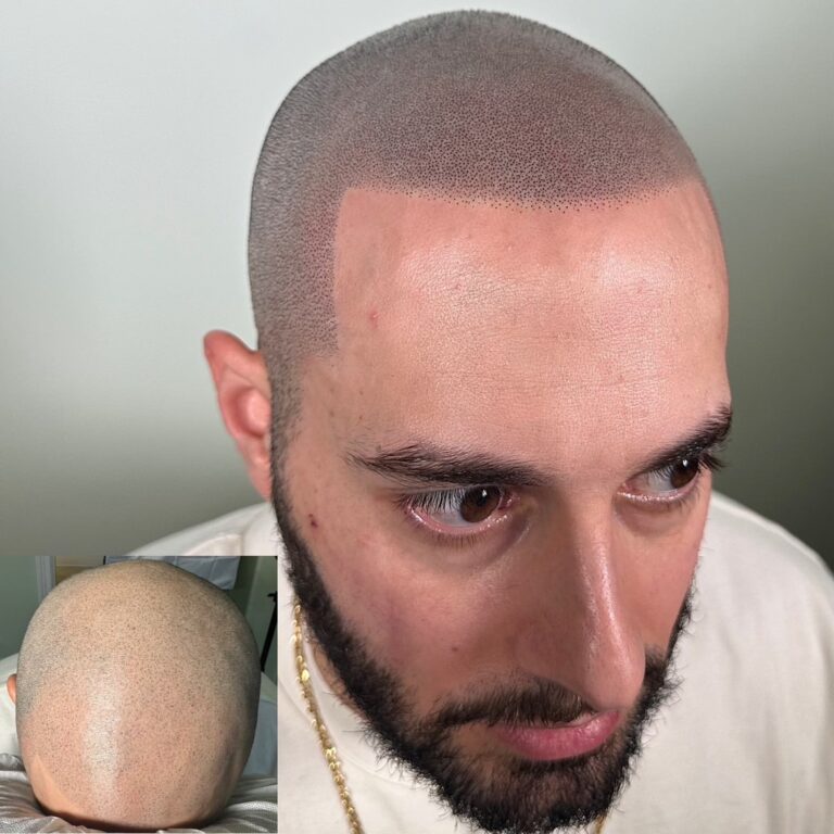 Scalp Micropigmentation