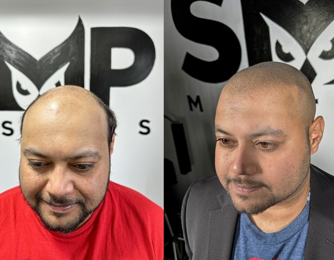 Hair Scalp Pigmentation