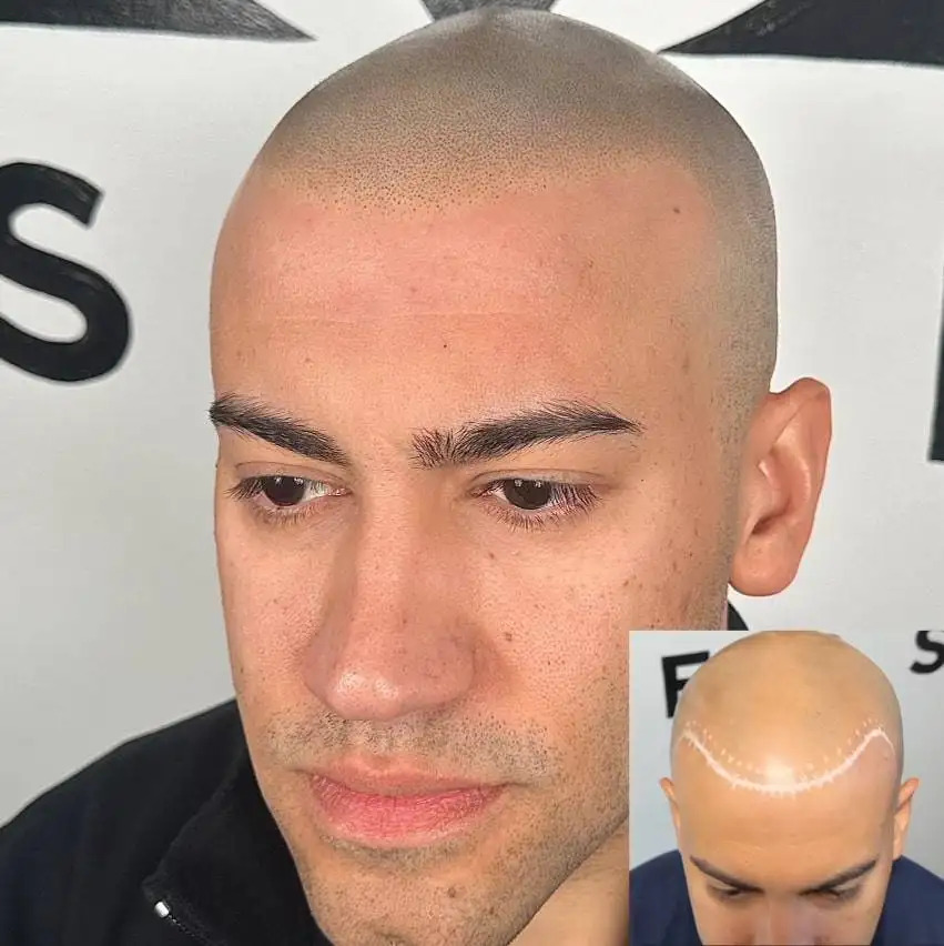 Best Scalp Micropigmentation