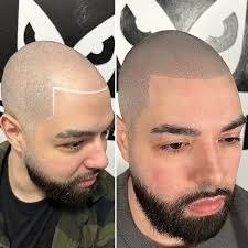 Scalp Micropigmentation Staten Island