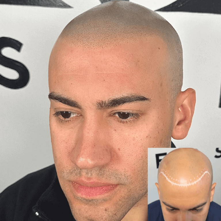 Achieve Natural-Looking Hair with Scalp Micropigmentation Treatment