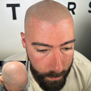 Scalp Micropigmentation in Staten Island