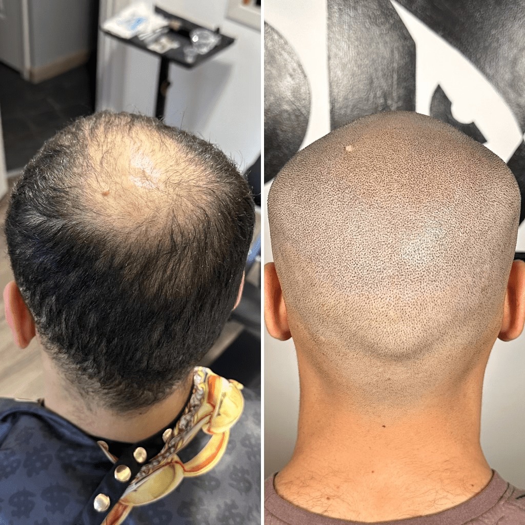 Scalp Micropigmentation