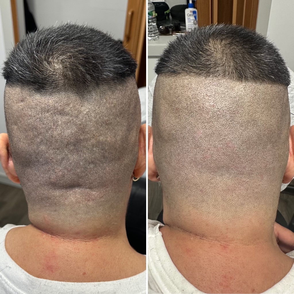 Scalp Micropigmentation In Staten Island