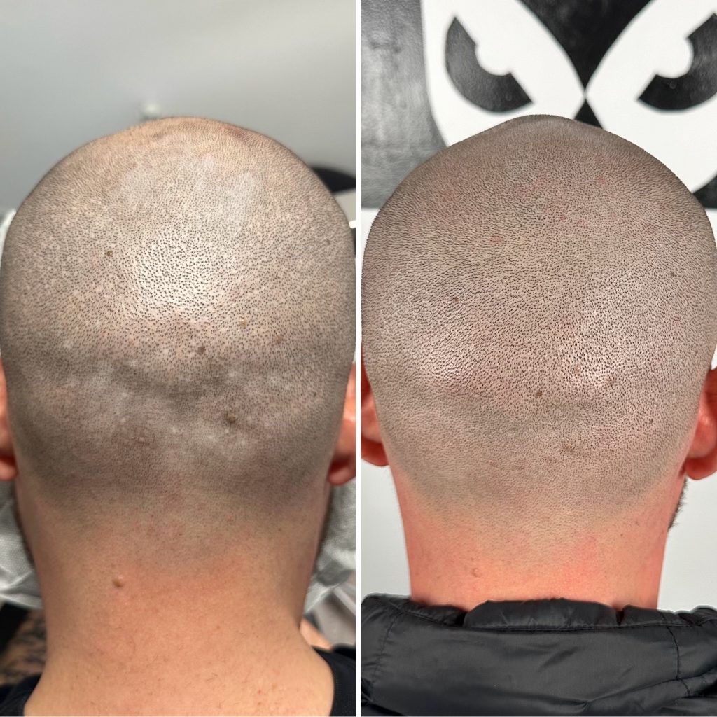 Best Scalp Micropigmentation in the World