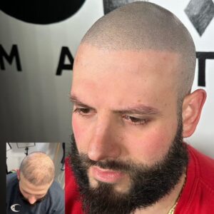 Scalp Micropigmentation in Long Island