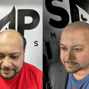 Alopecia Solutions Treatment