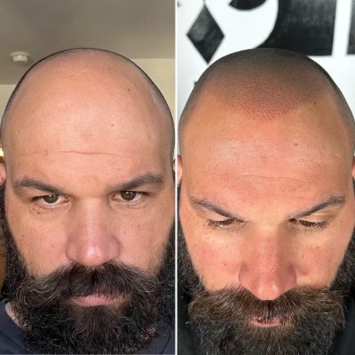 Scalp Micropigmentation LI