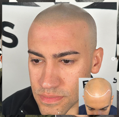 Scalp Micropigmentation Long Island