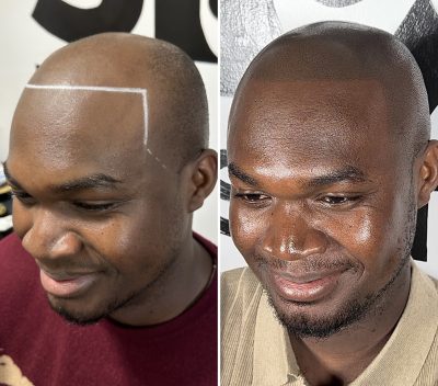 Scalp Micropigmentation Long Island