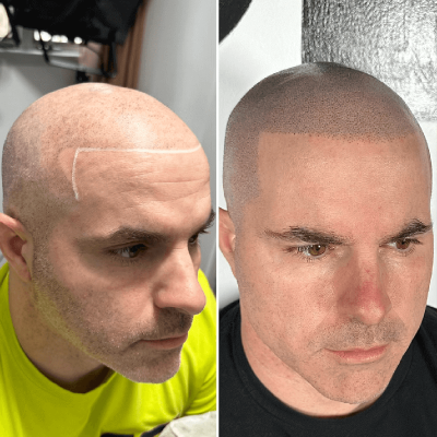 Scalp Micropigmentation In Staten Island