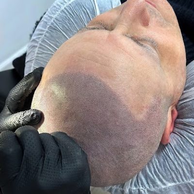 Scalp Micropigmentation Regrets