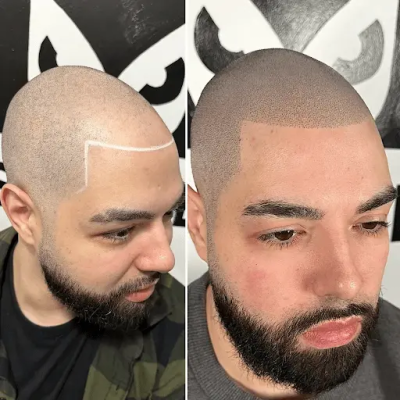 Scalp Micropigmentation